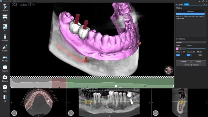 Intelligent Implant Planning Software